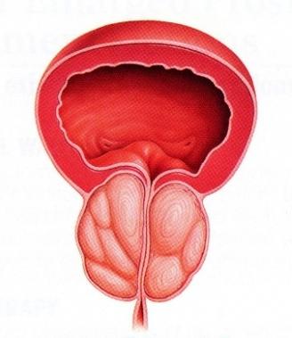 prostata adenom diagnose